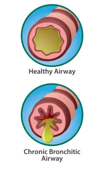 healthy vs. bronchitic airway