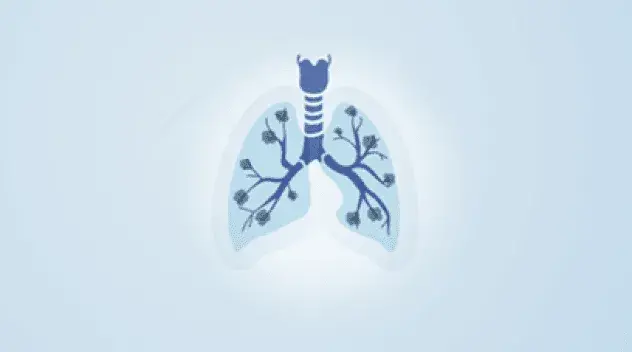 A stylized depiction of a lung with COPD.