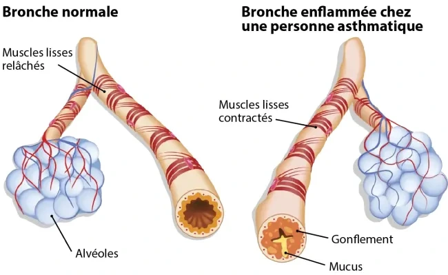 bronche normal et enflammee