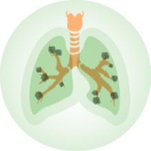 Vivre avec la bronchectasie pulmonaire