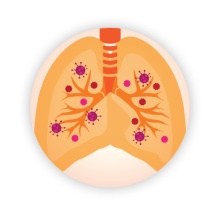 Vivre avec la maladie pulmonaire des mycobactéries non tuberculeuses (MNT)